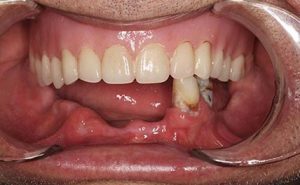 Closeup of missing lower arch of teeth