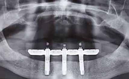 X-ray of Trefoil implant