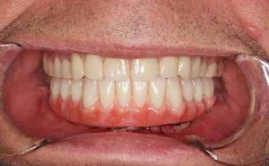 Closeup of dental bridge delivery