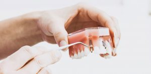 Hands holding an acrylic model of an arch of teeth using a dental implement to highlight a dental implant fixture