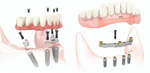Two side by side illustrations of All-on-4 prosthetic arches showing how parts fit together