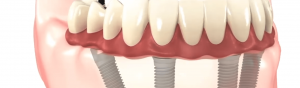 Implant supported denture graphic