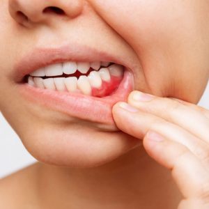 patients with red inflammed gums
